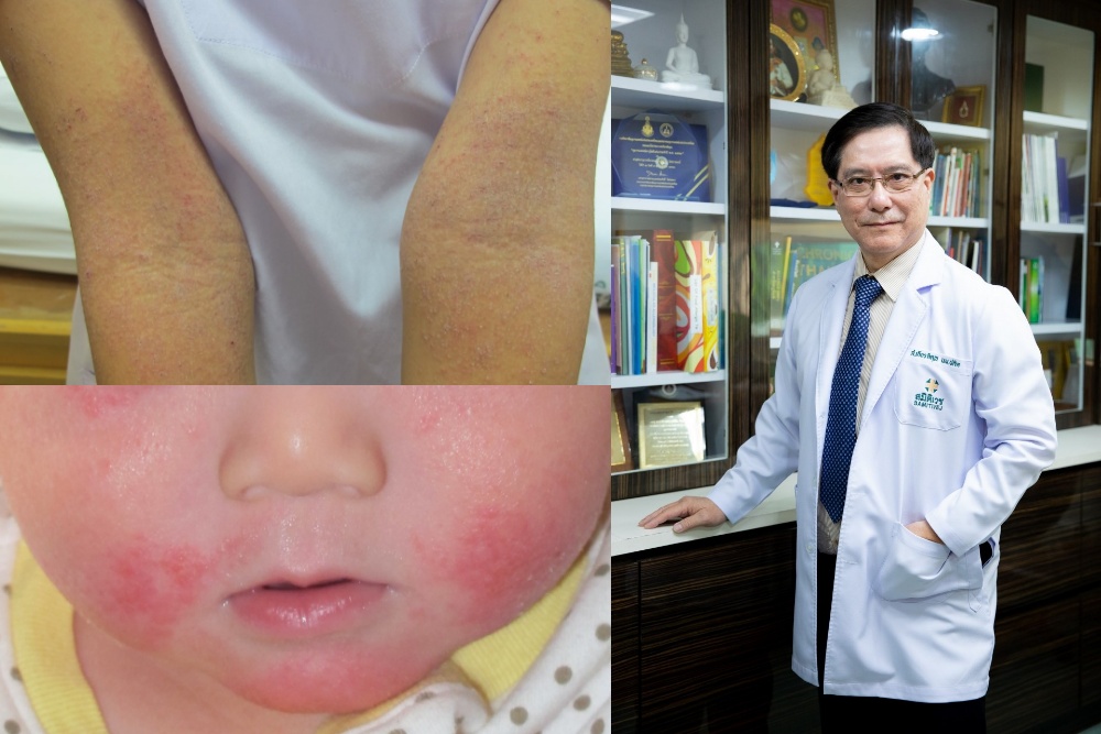 แพทย์เตือน วิกฤติฝุ่น PM 2.5 ตัวการทำ ‘ผื่นภูมิแพ้ผิวหนัง’ กำเริบ