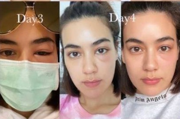 "คิมเบอร์ลี่" โพสต์เตือนภัยฝุ่น PM 2.5 ระวัง! แพ้​จนตาบวม