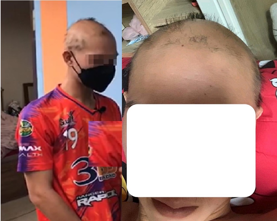 ช็อก! หนุ่มผมร่วงหมดหัวหลังฉีดวัคซีนซิโนแวคเข็ม 2 