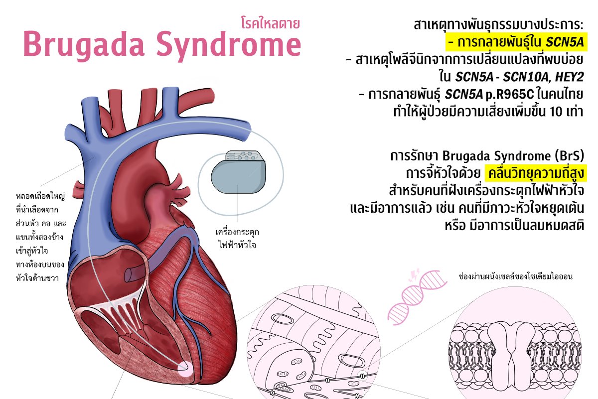 “โรคใหลตาย” ภัยเงียบชายไทย  ควรใส่ใจ ก่อน “หลับไม่ตื่น”