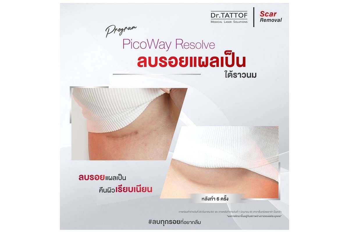 บอกลาทุกรอยแผลเป็นจากศัลยกรรม ด้วยนวัตกรรมเลเซอร์จาก Dr.TATTOF