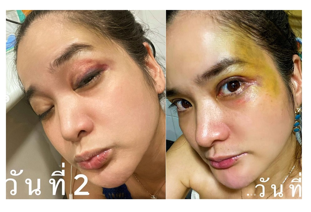 อุทาหรณ์ !!! คนเล่นสเก็ตบอร์ด 'ปอย ปวีณา' เตือนต้องมีอุปกรณ์พร้อม