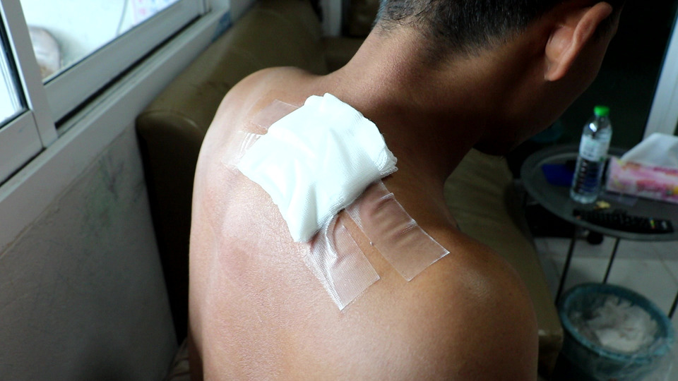 ครอบครัวคาใจ! หนุ่มถูกตะขอเกี่ยวปาล์ม เย็บแผลกลับบ้าน ก่อนพบลมรั่วในช่องเยื่อหุ้มปอด 