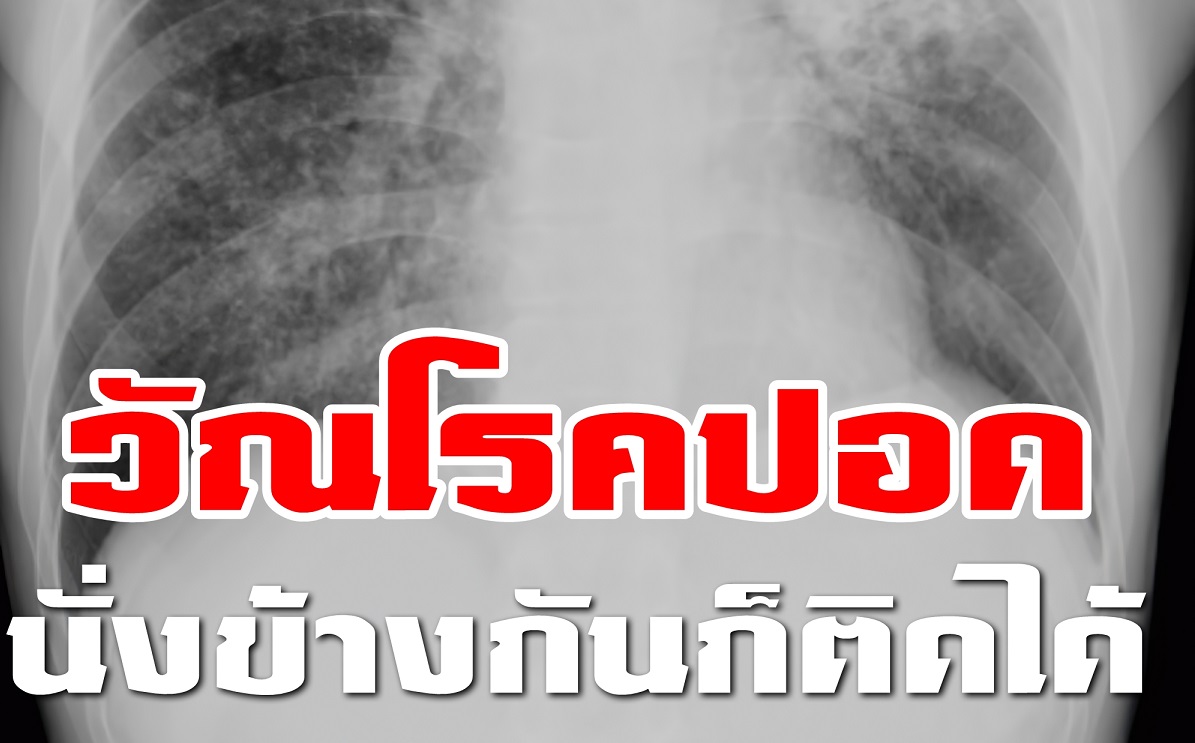 ‘วัณโรคปอด’ นั่งข้างก็ติดได้หมอแนะคนเคยเยี่ยม ‘โรเบิร์ต สายควัน’ ควรไปตรวจ