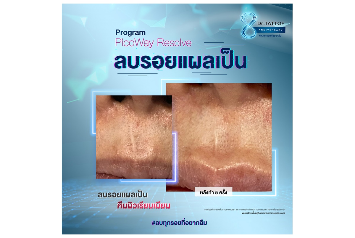Dr.TATTOF ดันเทคโนโลยีเลเซอร์ลบรอยแผลเป็น ชูความเป็นศูนย์เลเซอร์ครบวงจร