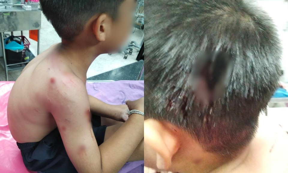 "ย่า" ร้องสื่อหลานชายวัย 6 ขวบถูกสุนัขขย้ำหัวเหวะ เจ้าของท้าอยากได้เยอะให้ไปฟ้องเอา