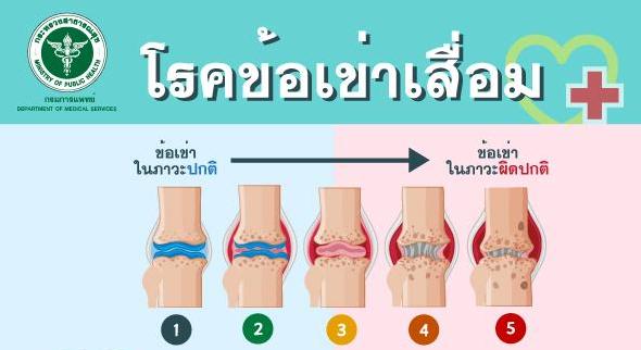 แพทย์เตือนอายุ 40 ขึ้นไป  เสี่ยง “ข้อเข่าเสื่อม” เพศหญิงเป็นมากกว่าชาย 2-3 เท่า