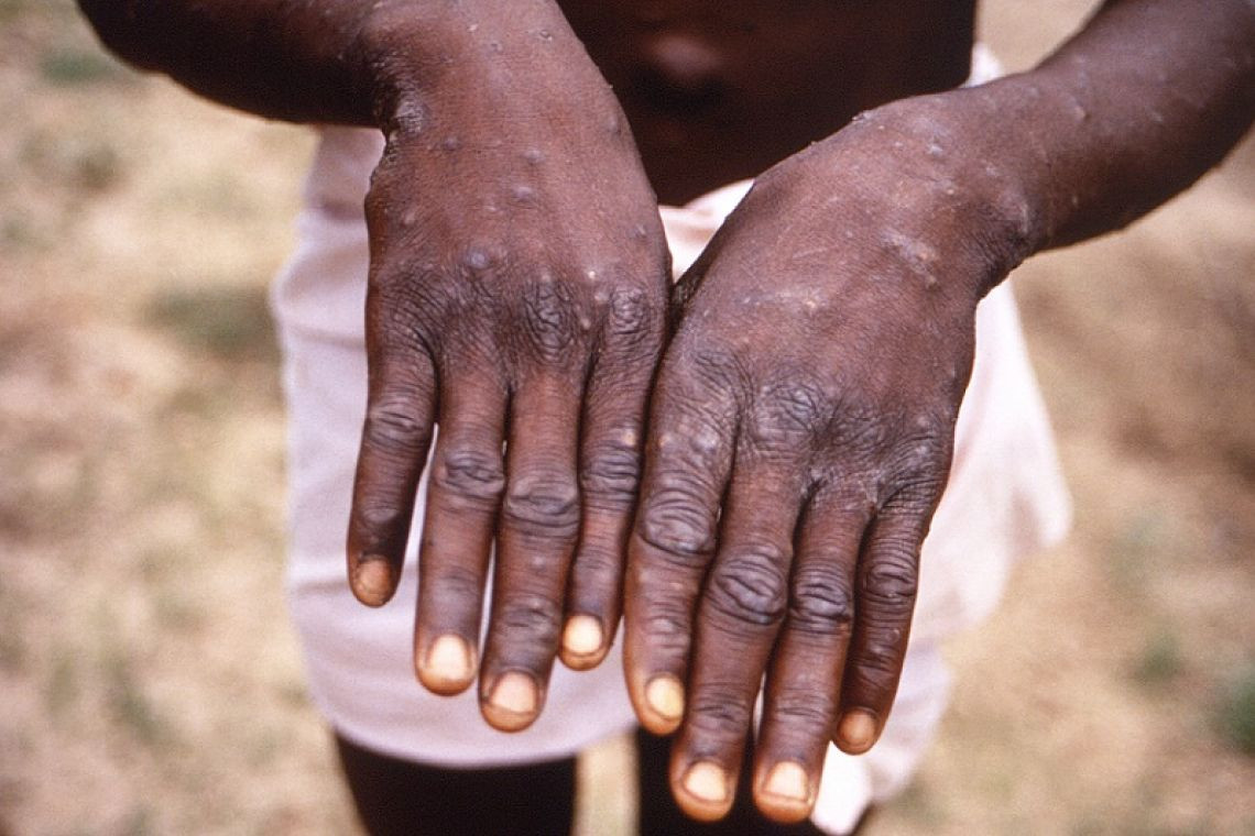 รุนแรงเพิ่มขึ้น! "แอฟริกา" พบผู้ป่วยโรค "ฝีดาษลิง" พุ่งกว่า 6 หมื่นราย เสียชีวิตแล้วกว่า 1 พัน