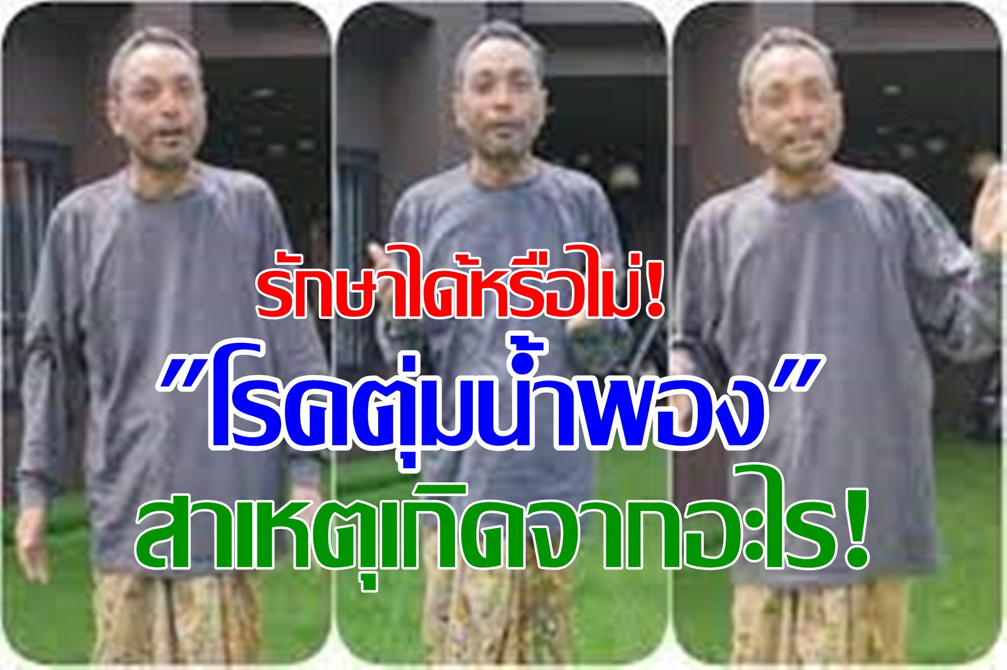  รักษาได้หรือไม่! รู้จัก "โรคตุ่มน้ำพอง" สาเหตุเกิดจากอะไร! 