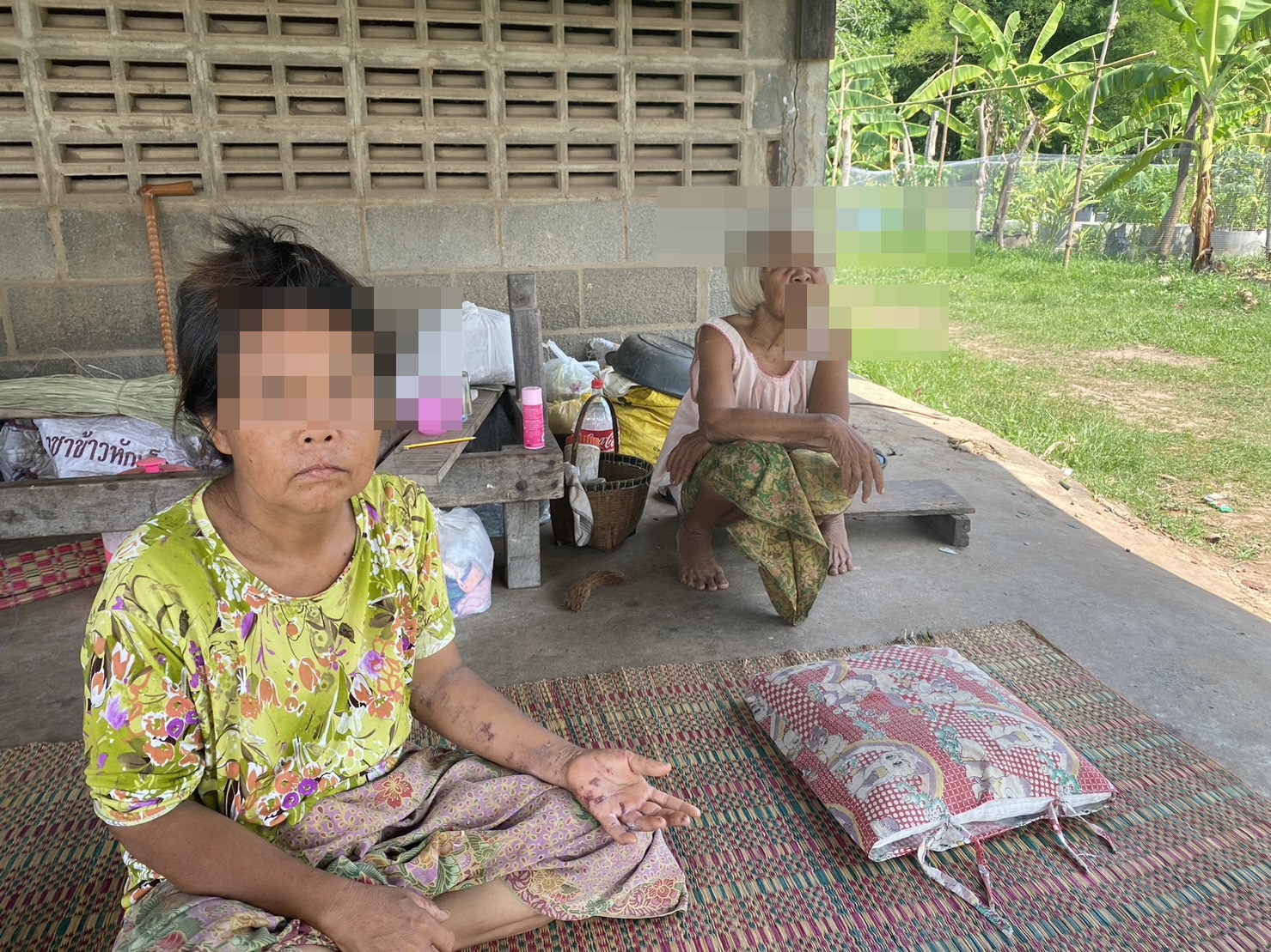 ชาวบุรีรัมย์โอดอาบน้ำประปาหมู่บ้านแล้วเป็นแผลพุพอง ด้านนายก อบต.เตรียมตั้งงบแก้ไขปัญหา