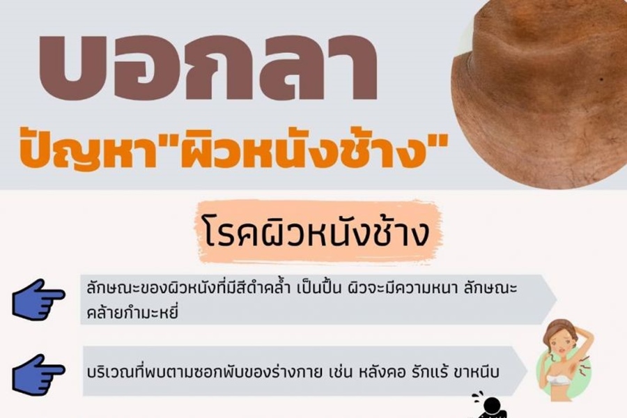 คอดำบอกโรค! "ผิวหนังช้าง" ห้ามใช้น้ำมัน E85 ขัดอันตราย 