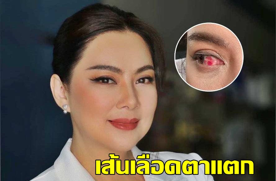  "บุ๋ม ปนัดดา" โหมงานหนักจนเส้นเลือดในตาแตกแฟนคลับแห่เป็นห่วง