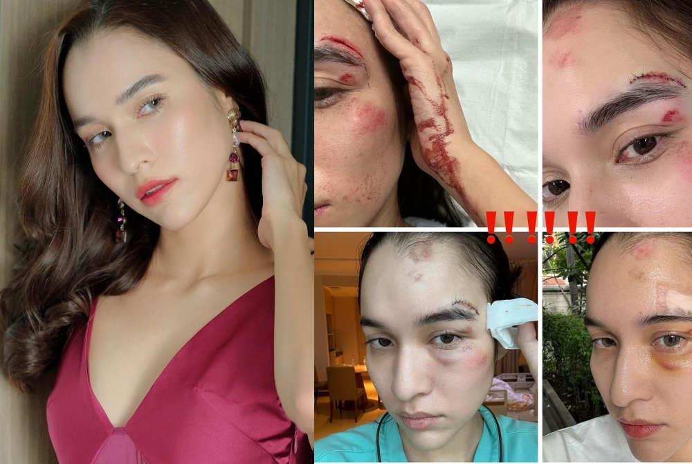 แฟนคลับช็อก! "หยาดทิพย์"เปิดภาพเลือดอาบน็อกล้มหัวกระแทกเย็บ13เข็ม