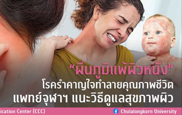 "ผื่นภูมิแพ้ผิวหนัง" โรครำคาญใจทำลายคุณภาพชีวิต แพทย์จุฬาฯ แนะวิธีดูแลสุขภาพผิว