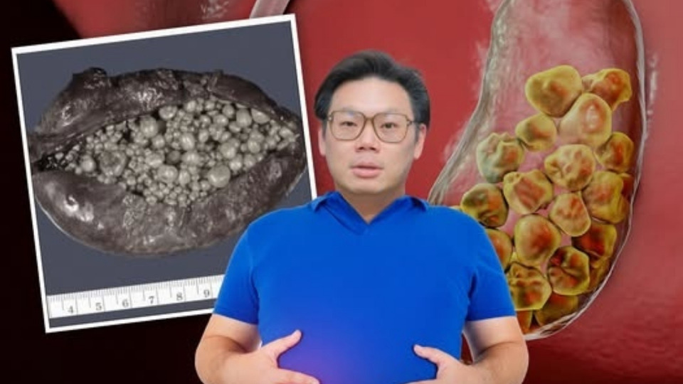  เช็ก 5 สัญญาณอันตรายก่อนสายเกินแก้ “หมอเจด” เตือนแน่นท้องอย่าชะล่าใจ! อาจไม่ใช่กรดไหลย้อน เสี่ยง “นิ่วในถุงน้ำดี”