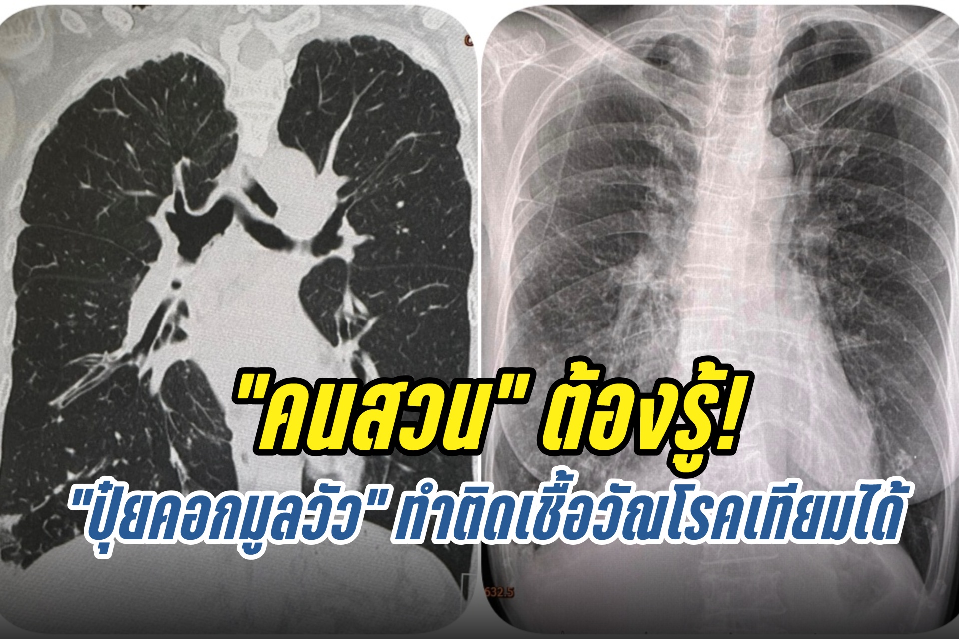 “คนสวน” ต้องรู้! “ปุ๋ยคอกมูลวัว” ทำติดเชื้อวัณโรคเทียมได้