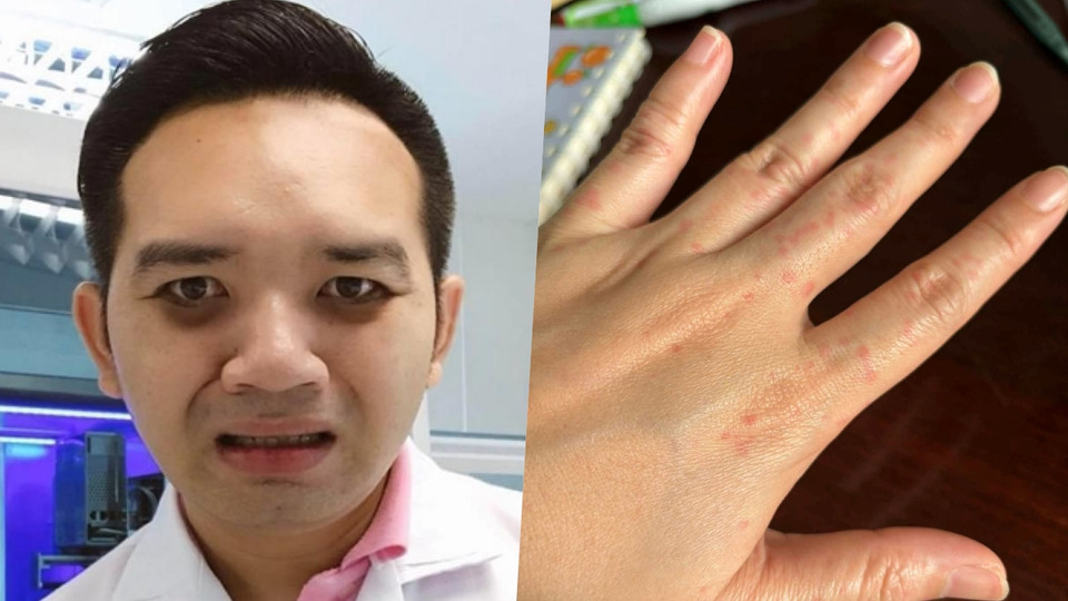 “หมอแล็บ” เตือน PM2.5 ทำผื่นคัน-สิวเห่อ แนะวิธีป้องกันด่วน