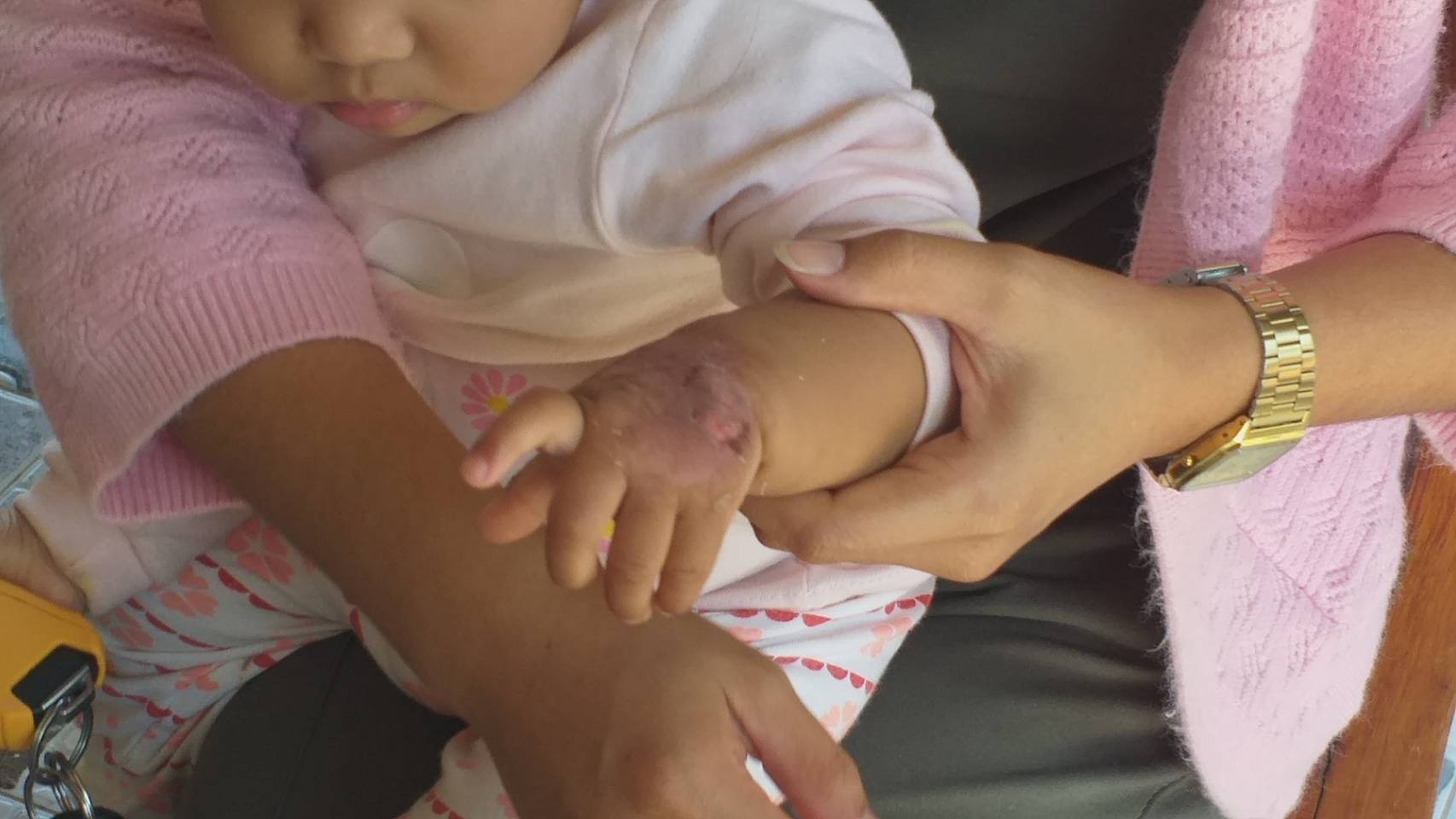 ยืนอกรับผิด!! ผอ.รพ.กุมภวาปี ยอมรับเหตุน้ำเกลือรั่วไหลจนมือเด็กไหม้