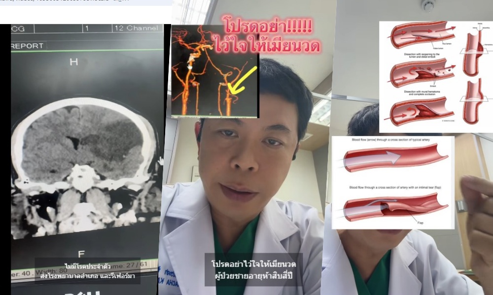 อย่าไว้ใจให้เมียนวด! "แพทย์" โพสต์คลิปเป็นอุทาหรณ์ คนไข้สมองตายบางส่วน แขนขาอ่อนแรง
